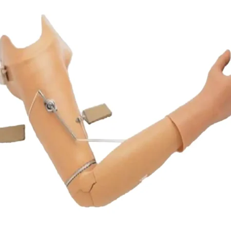 Custom-Made Above-Elbow Mechanical Arm Prosthesis
